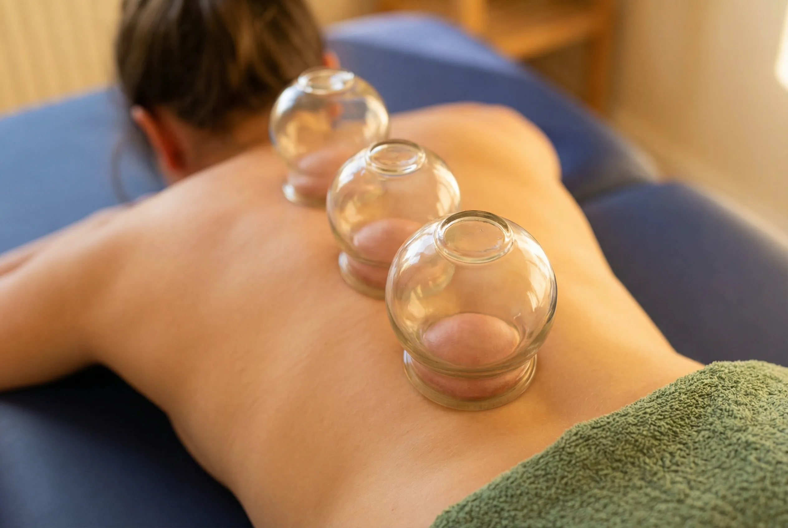 Schröpftherapie – Schröpfgläser auf dem Rücken Heilpraktikerin Aalen